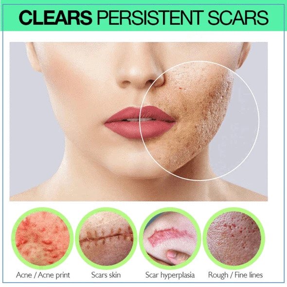 PRO niacinamidni serum za brazgotine - Image 3