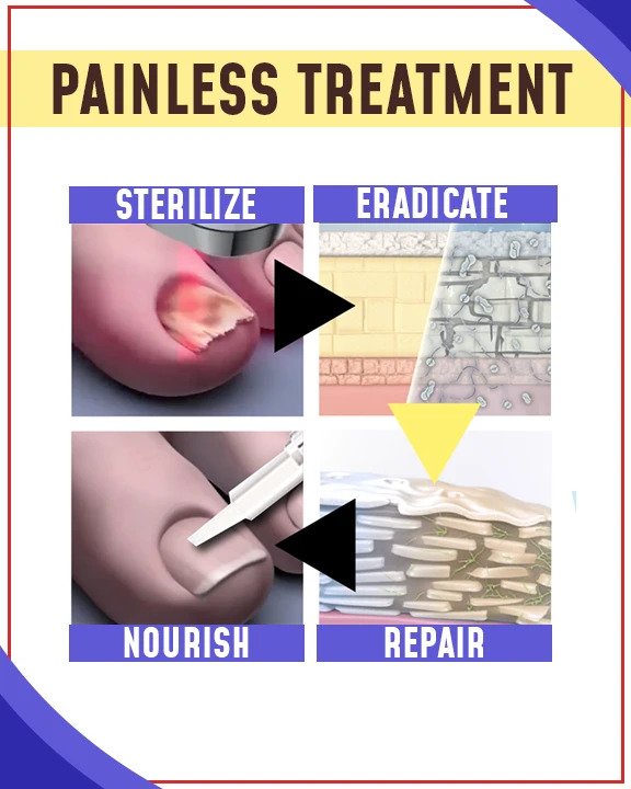 Kompleti za zdravljenje z modro svetlobo proti glivicam - Image 2