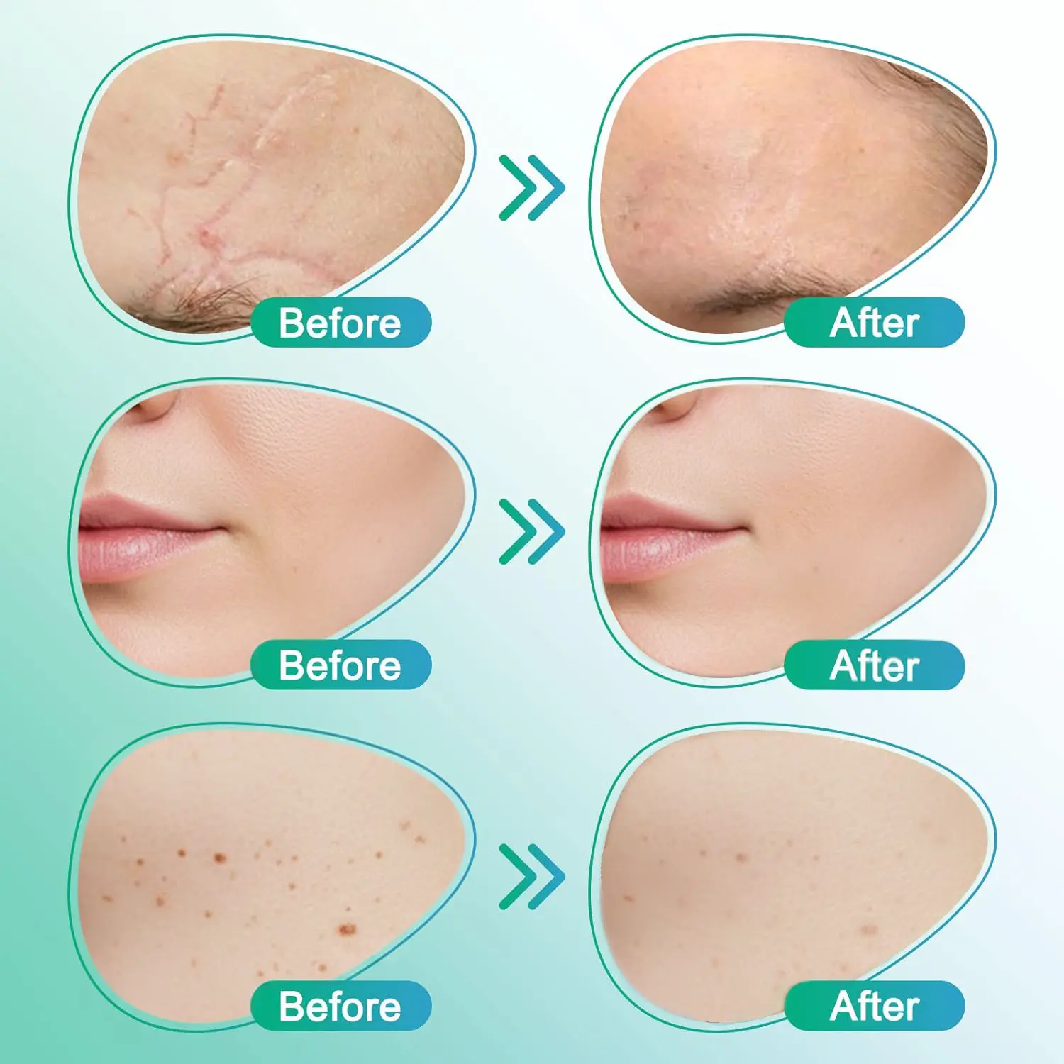 𝗖𝗮𝗿𝗲𝗕𝗿𝗲𝗲𝘇𝗲® obliž za nego z mikroiglami 3 v 1 - Image 5