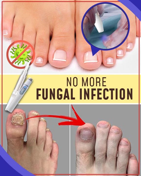 Kompleti za zdravljenje z modro svetlobo proti glivicam - Image 3