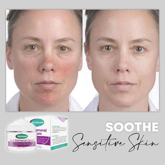 Medease Skin Rebound krema - Image 6