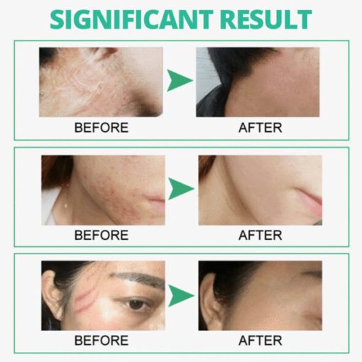Skin Rebound Scarless krema - Image 6