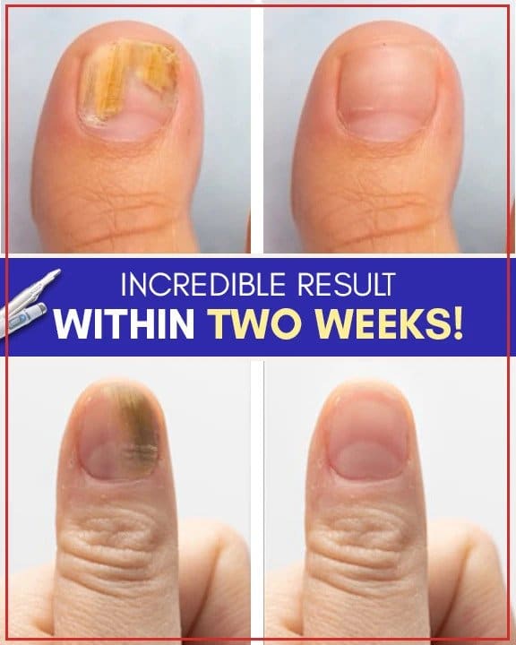 Kompleti za zdravljenje z modro svetlobo proti glivicam - Image 5